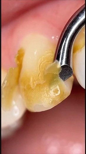Plaque Removal Procedure. You’re Welcome.