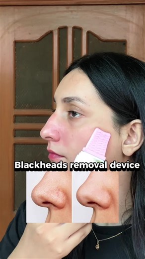 Blackheads & whiteheads removal device @officialmultypak . . Budget friendly and easy to use 👍 . . . . . . #skin #skincaretips #skincare #blackheads #whiteheads #acne #blackheadmask #device #glowyskin #clearskin #peeloffmask #facemask #explore #insta #instareels #instagood #fyp #foryou #fanpage #areejbajwa #skincareroutine #skincareproducts #facecare #blackheads #facecare #hydrafacial #areejbajwa #tiktokviral #tiktok #viralvideos #trendin #trendingvideo #blackheads #blackheadsremoval #whitehead