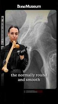 Femoral Head Necrosis Explained