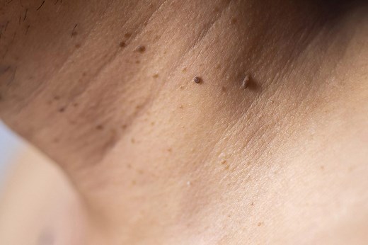 How to Get Rid of Skin Tags the Right Way, According to Expert Dermatologists