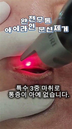 부평타임의원 완전무통 아이라인 문신제거. 통증이 없습니다.