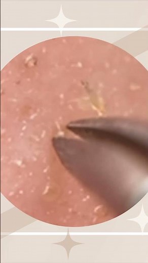 【角栓やすみ / Pore Holiday】ピンセットで角栓除去 #角栓 #ピンセット #気持ちいい #blackhead #tweezers #Satisfying