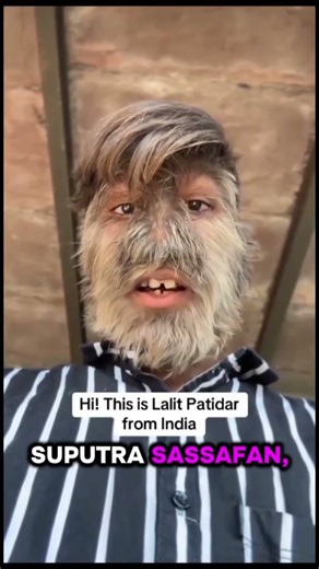 most hairy person in the world😨