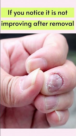 How to treat an Allergic reaction to Acrylic nails