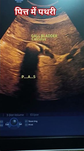 gallbladder stone 🪨 #ultrasound #baby #pregnant #viralshort