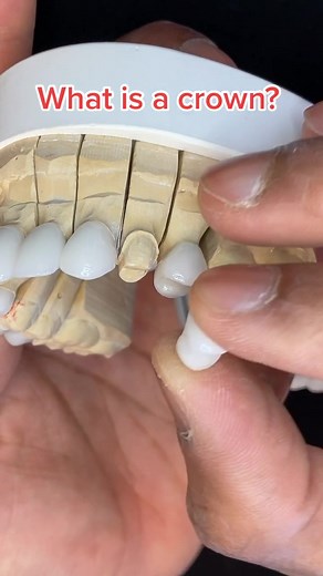 Understanding Dental Crowns: Definition and Facts