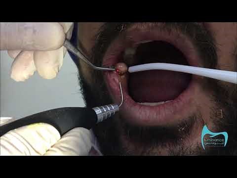 Fibroma removal by Diode laser