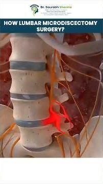Slip Disc Treatment: How Lumbar Microdiscectomy Surgery Works #neurosurgeon #spinedisorders |