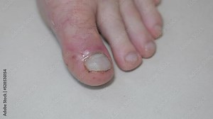 Bruised toe. Ointment for the treatment of bruises and bruises