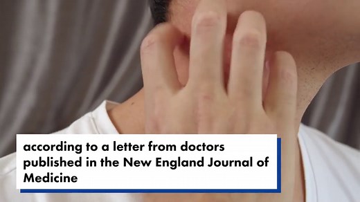 Side effect of Moderna vaccine may be a delayed skin rash, doctors warn