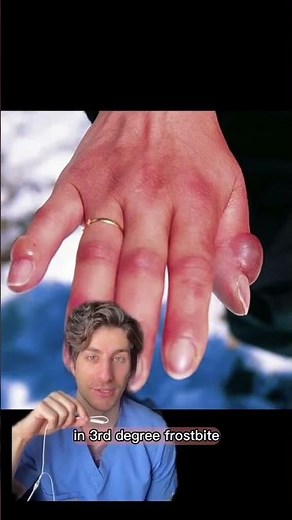 The 4 stages of FROSTBITE 🥶