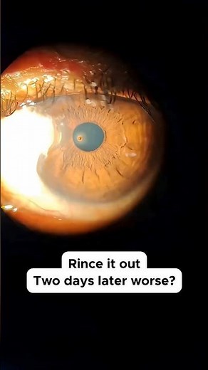Something Stuck in Your Eye? Corneal Scratch Warning | Surrey Optometrist