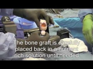 Osteochondral Transplant Knee Surgery • Video • MEDtube.net