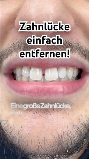 Remove gaps between teeth with the Flowable Injection Technique #flowableinjection #gap