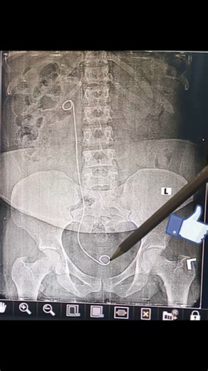 Understanding Kidney Stents: Types and Benefits Explained