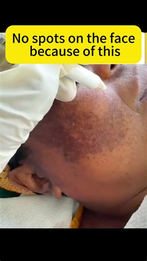 Qw Time to say bye dark spots and melasma in just 2 weeks#spots #fyp #aobenz