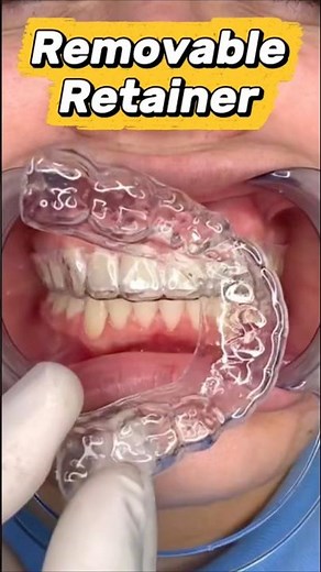 Stop your teeth from shifting! 🛑 Removable Retainers #orthodontist #braces #dentist