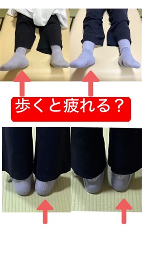 足首の捩れ。歩くと疲れる、痛い。 #久留米#小郡#八女#パーキンソン病#脳梗塞後遺症#片麻痺#すくみ足#慢性腰痛#膝痛改善