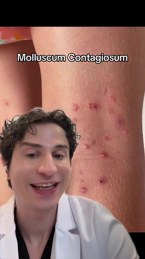 Understanding Molluscum Contagiosum: A Skin Condition Explained