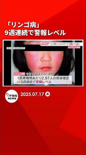 [Infectious diseases] "Apple disease" at warning level for 9th consecutive week, "Herpangina" for...