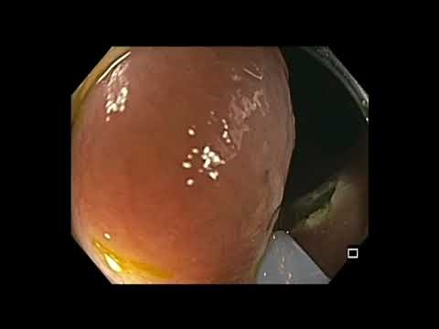 Colonoscopy: Ascending Colon EMR - Challenging Intubation & EMR