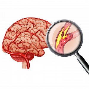 How to recover from Brain Stroke ? #Health #science | Doctor ASKY