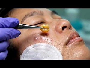 Ultimate zit popping with precision tweezer techniques, #1234