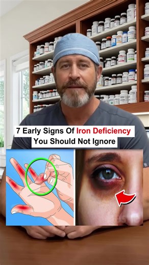 7 early signs of iron deficiency you should not ignore #usa #usa_tiktok #usa🇺🇸 #health #healthtips