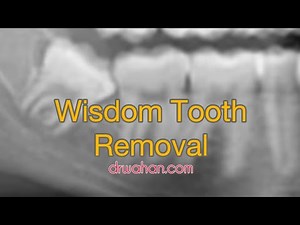 Best Technique for Wisdom Tooth Extraction
