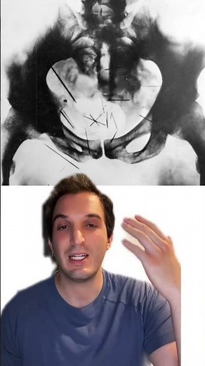 One of the most famous cases in medical history, the x-rays of serial killer Albert Fish