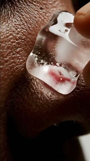 Dermatologist Explains Ice on Pimples ❄️ #Shorts