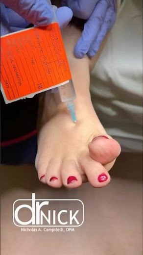 Injecting a foot before surgery!