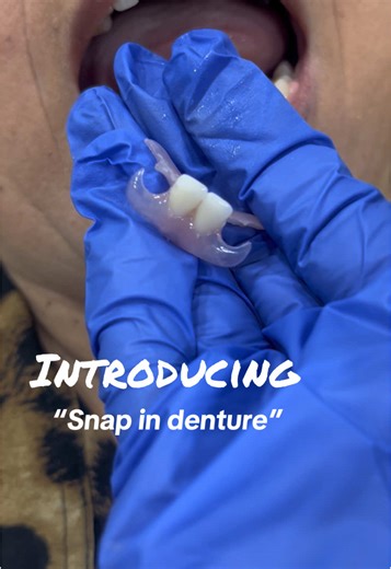 Transform Your Smile with Snap-In Dentures