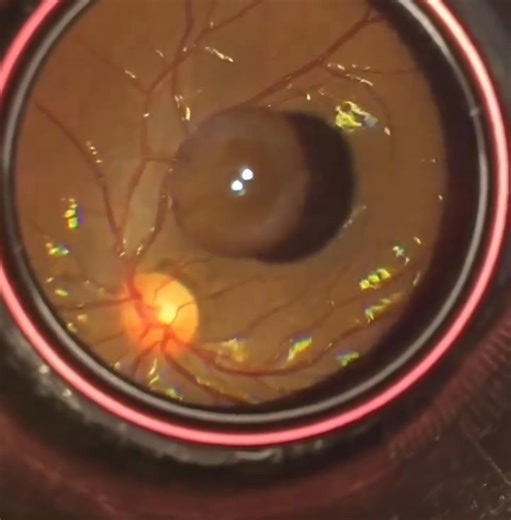 8.1K views · 119 reactions | Vitreous Cyst A 20-year-old female...
