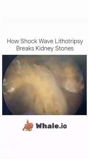 Science | Shock Wave Lithotripsy (SWL) is a non-surgical medical procedure used to break kidney stones into tiny fragments using high-energy sound... | Instagram