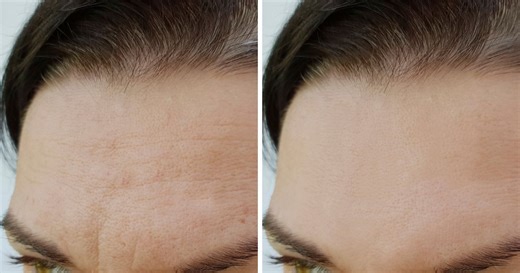 Adieu le botox, ce massage du visage en 3 étapes fait disparaître les rides du front naturellement
