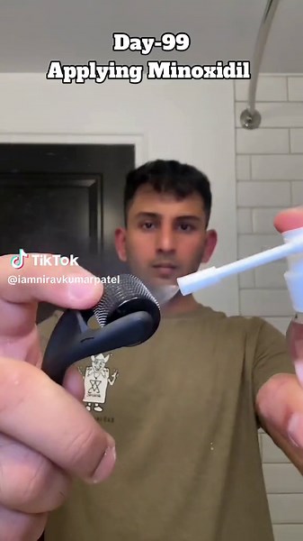 Restoring Hairline with Minoxidil & Finasteride: Day 99 Progress