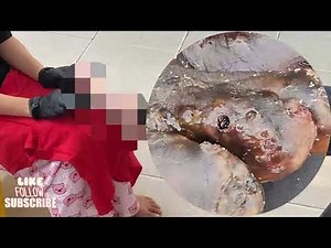 🤯 Extreme Jigger Removal – Hidden Parasites Under Rotting Skin! #MD205