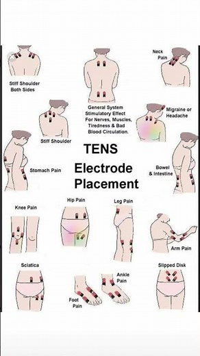tens electrode placement #physiotherapist #motivation #success