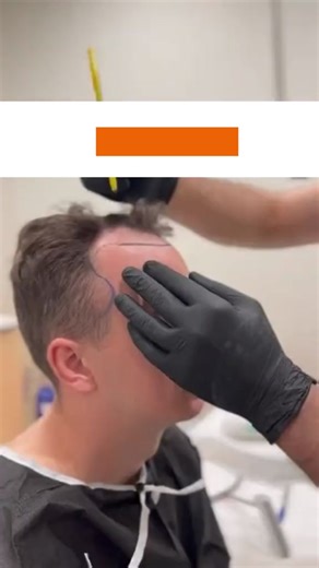 From baldness to fullness with #fegplus #hairserum