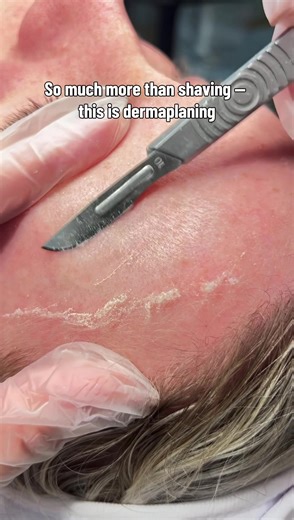 Benefits of Professional Dermaplaning for Radiant Skin