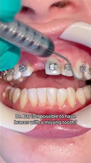 How We Hide A Missing Tooth During Braces