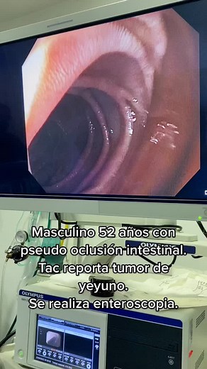 Enteroscopia #endoscopy #surgery #gastroenterology