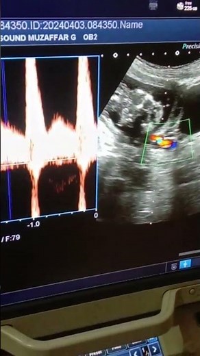 Left uterine artery Doppler