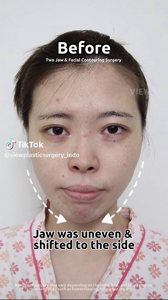 I had my jaw corrected with two jaw & facial contouring surgery in Korea This model is exclusively for use only on View Plastic Surgery channel, and any unauthorized use is prohibited. Copyrights to images and all other materials related to this content belong to View Plastic Surgery and you may be liable for unauthorized distribution and or reproduction of the same without written consent. Hasil operasi tiap individu berbeda, dan mungkin ada efek samping seperti pendarahan dan peradangan. #plas