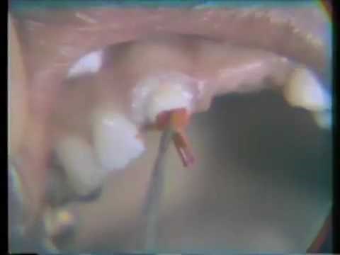 Fabrication of a Direct Duralay Post