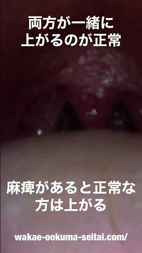 【喉の検査】「あ～」と言うと”のどちんこ”はどうなるか？
