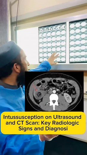 Dr Nadeem Ullah | How intussuception appears on ultrasound and CT scan watch this video 📷 #intussusception #ctscan #mari #ultrasound #radiology... | Instagram