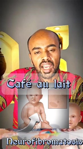 #Café au lait Spot #NeurofibromatosisType 1 #drabdi #KidsHealth #ድሬዳዋ #pediatrician #fyp #Baby #Infant