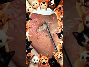 Blackheads Removal | Acne Treatment and Very Satisfying Satisfying Pimple pop #blackheads